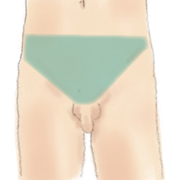 Vライン脱毛
