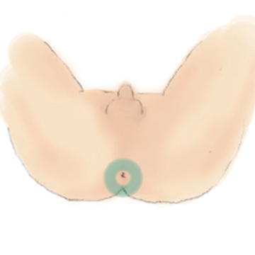 Oライン脱毛