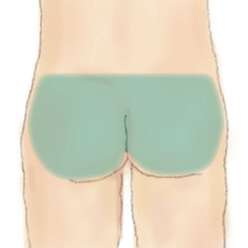 おしり脱毛
